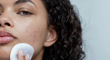 How do you get rid of acne scars?